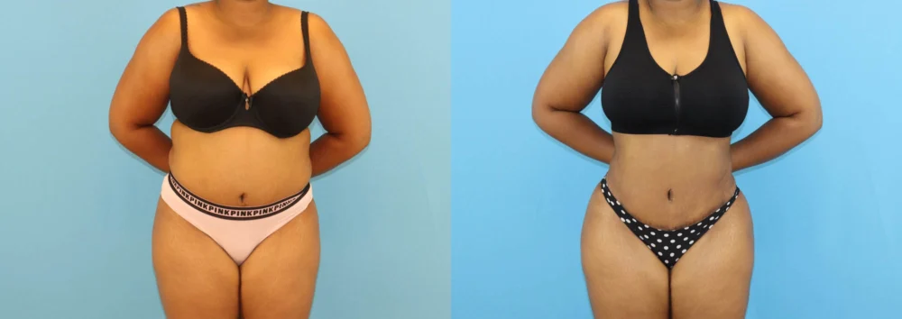 Brazilian Butt Lift case #5116