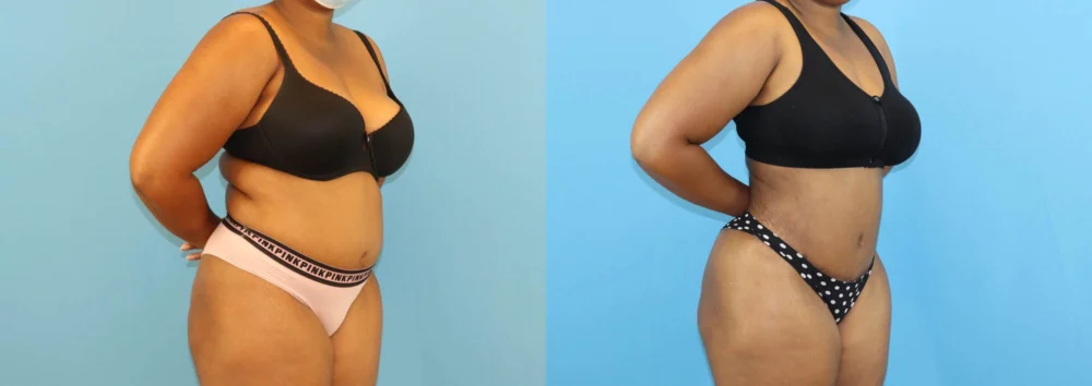 Brazilian Butt Lift case #5116