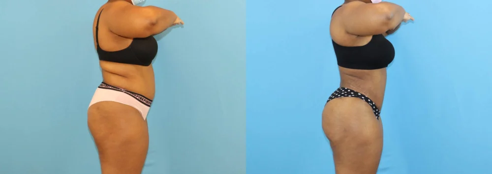 Brazilian Butt Lift case #5116