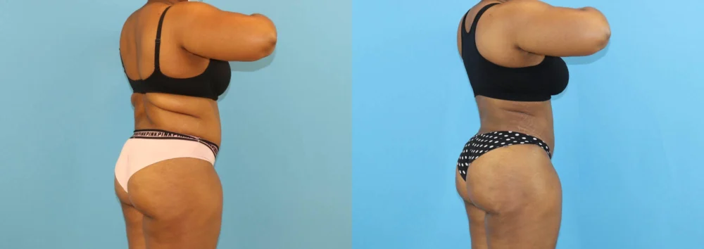 Brazilian Butt Lift case #5116