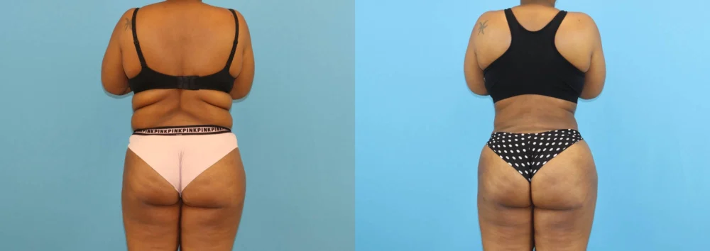 Brazilian Butt Lift case #5116