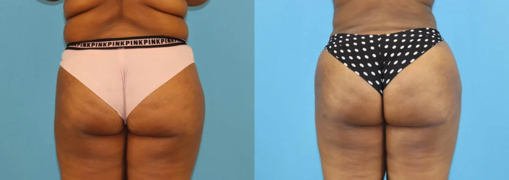 Brazilian Butt Lift case #5116