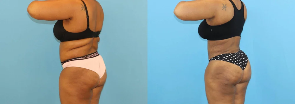 Brazilian Butt Lift case #5116