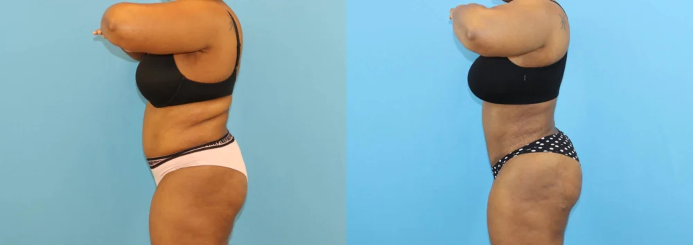 Brazilian Butt Lift case #5116