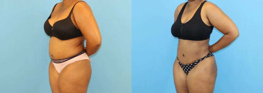 Brazilian Butt Lift case #5116