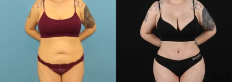 Brazilian Butt Lift case #5119