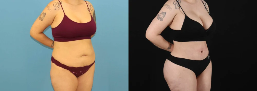 Brazilian Butt Lift case #5119