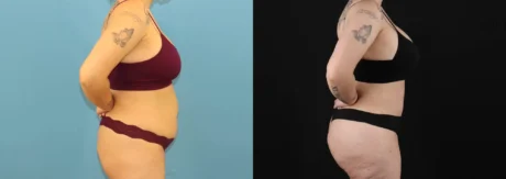 Brazilian Butt Lift case #5119