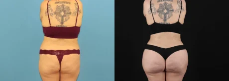 Brazilian Butt Lift case #5119