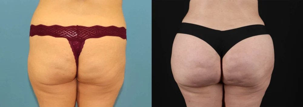 Brazilian Butt Lift case #5119