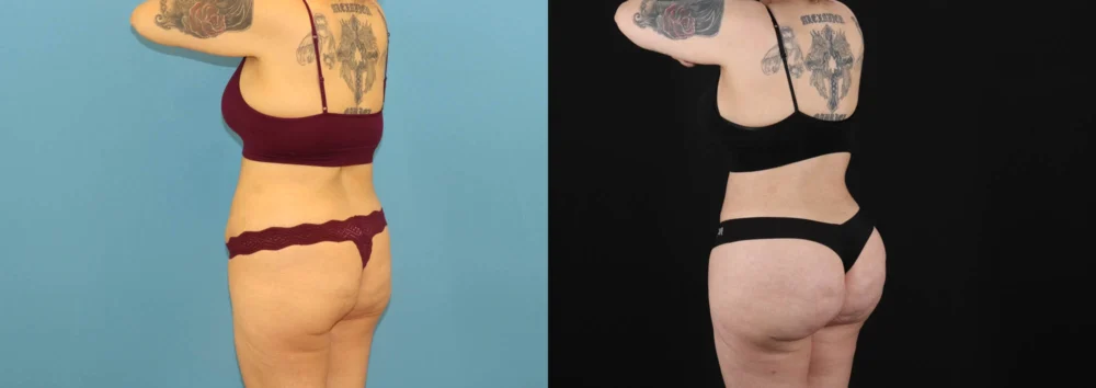 Brazilian Butt Lift case #5119