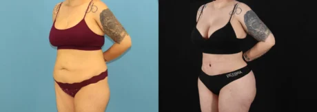 Brazilian Butt Lift case #5119