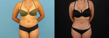 Brazilian Butt Lift case #5118