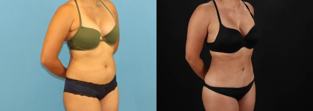 Brazilian Butt Lift case #5118