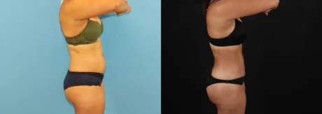 Brazilian Butt Lift case #5118