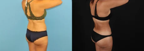 Brazilian Butt Lift case #5118