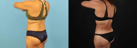 Brazilian Butt Lift case #5118