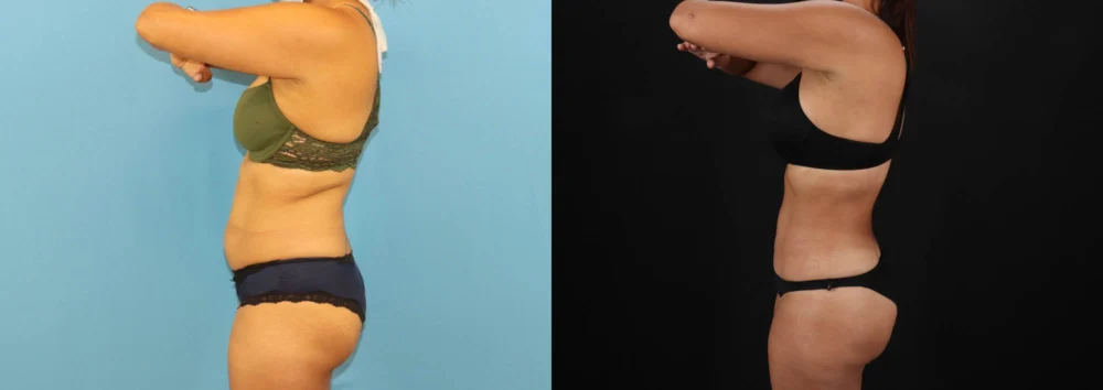 Brazilian Butt Lift case #5118