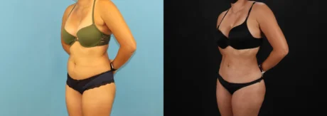 Brazilian Butt Lift case #5118