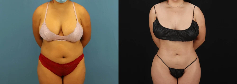 Brazilian Butt Lift case #5168