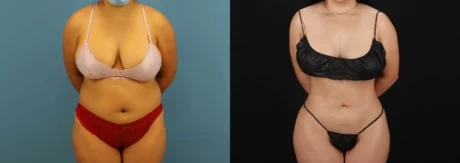 Brazilian Butt Lift case #5168