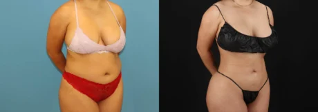 Brazilian Butt Lift case #5168