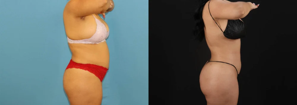 Brazilian Butt Lift case #5168