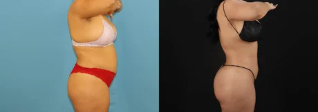 Brazilian Butt Lift case #5168