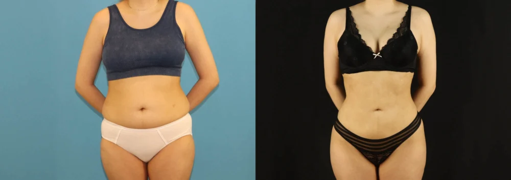 Brazilian Butt Lift case #5169