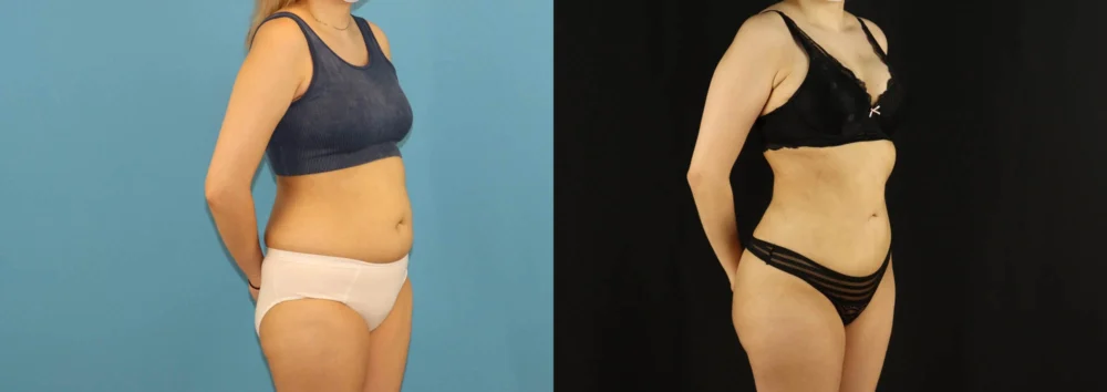 Brazilian Butt Lift case #5169