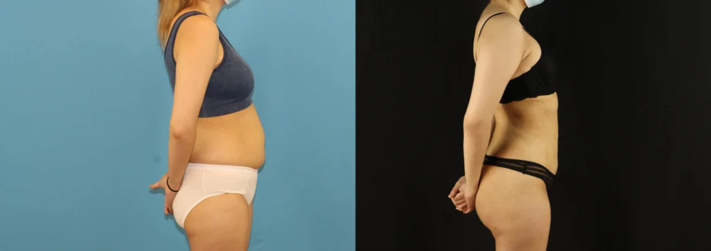 Brazilian Butt Lift case #5169