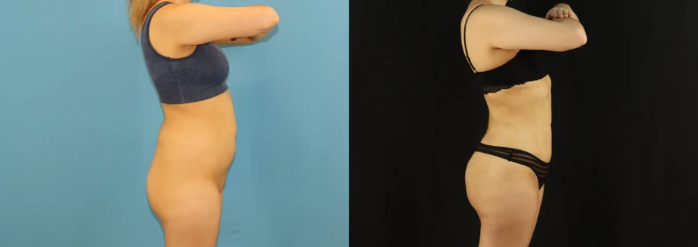 Brazilian Butt Lift case #5169