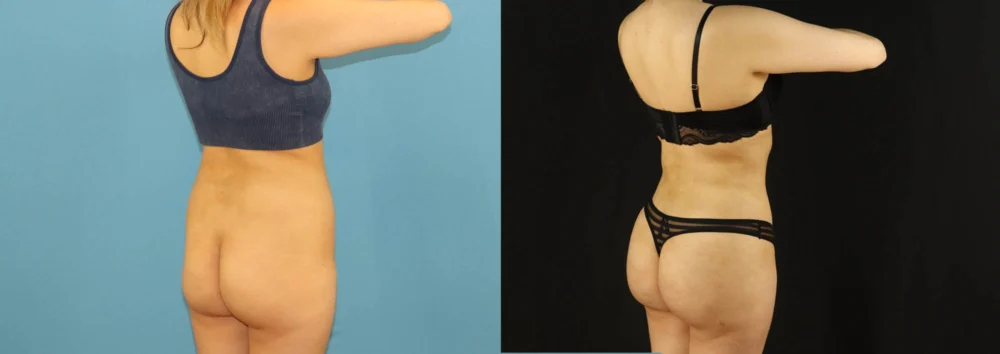 Brazilian Butt Lift case #5169