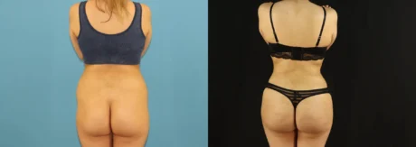 Brazilian Butt Lift case #5169