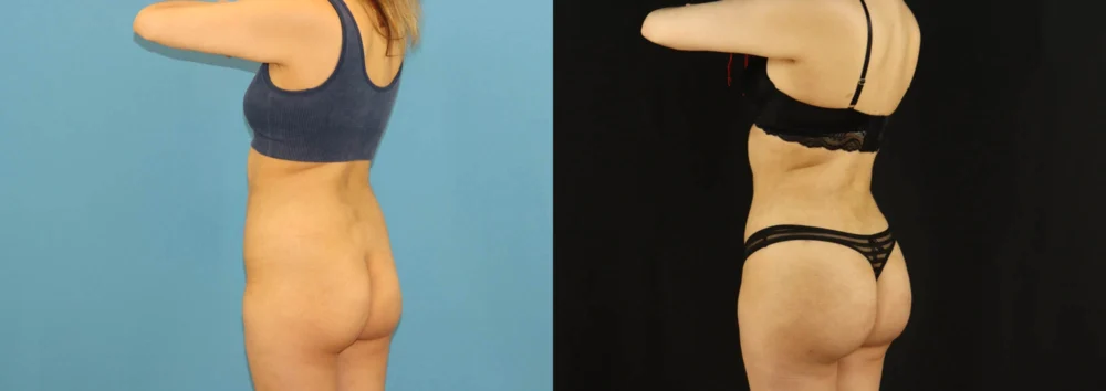 Brazilian Butt Lift case #5169