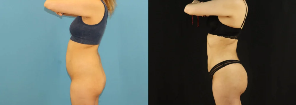 Brazilian Butt Lift case #5169