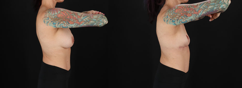 Implant Removal case #256480