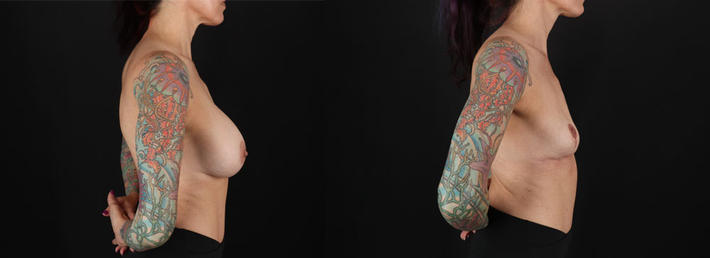 Implant Removal case #256480