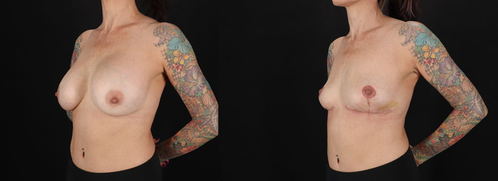 Implant Removal case #256480