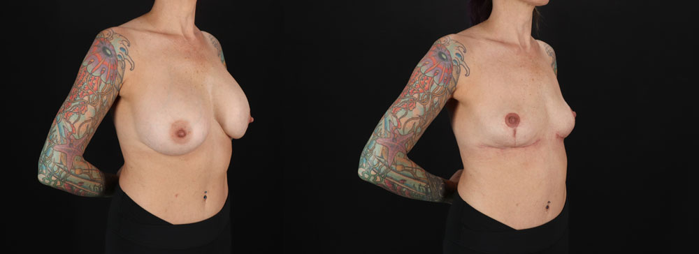 Implant Removal case #256480