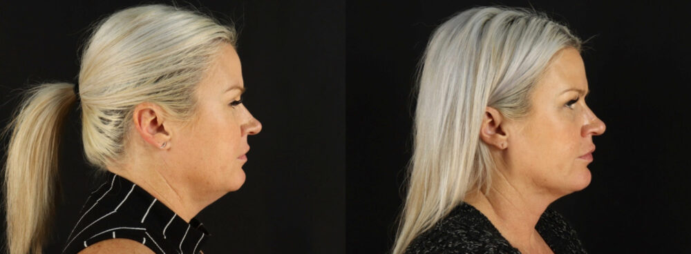 Fraxel Laser case #256590