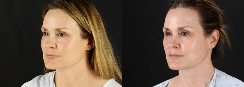 Fraxel Laser case #256593