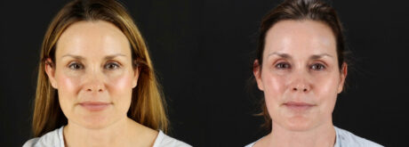 Fraxel Laser case #256593