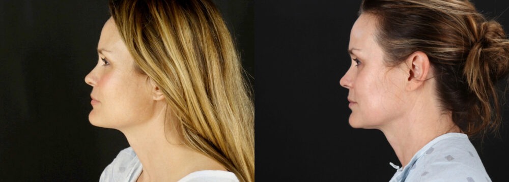 Fraxel Laser case #256593