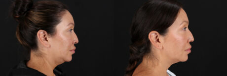 Fraxel Laser case #256591