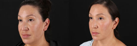 Fraxel Laser case #256591