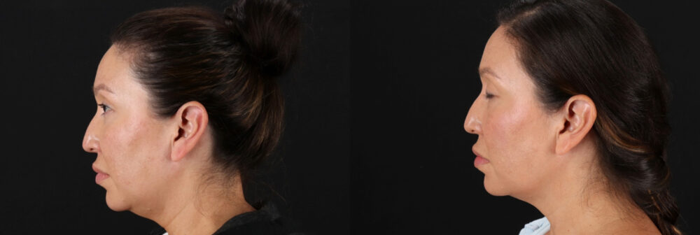 Fraxel Laser case #256591