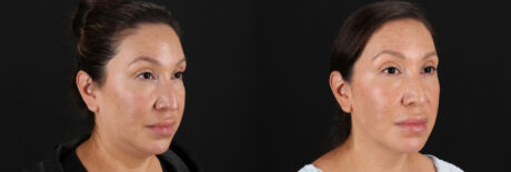 Fraxel Laser case #256591