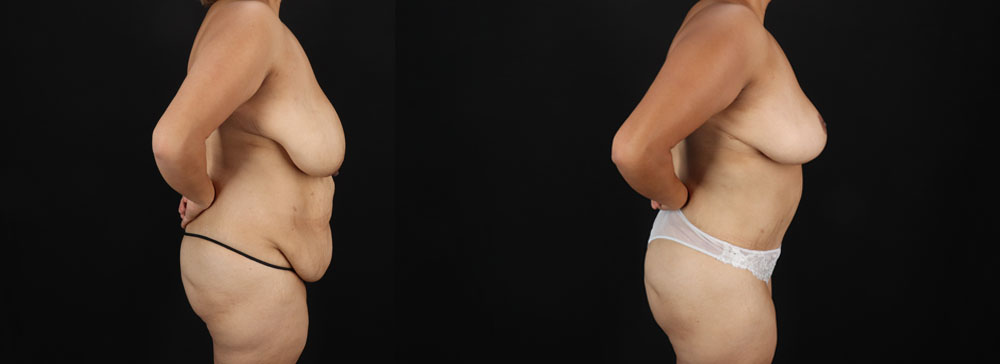 Post Bariatric Surgery (Massive Weight Loss) case #256488