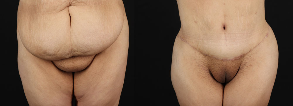 Post Bariatric Surgery (Massive Weight Loss) case #256488